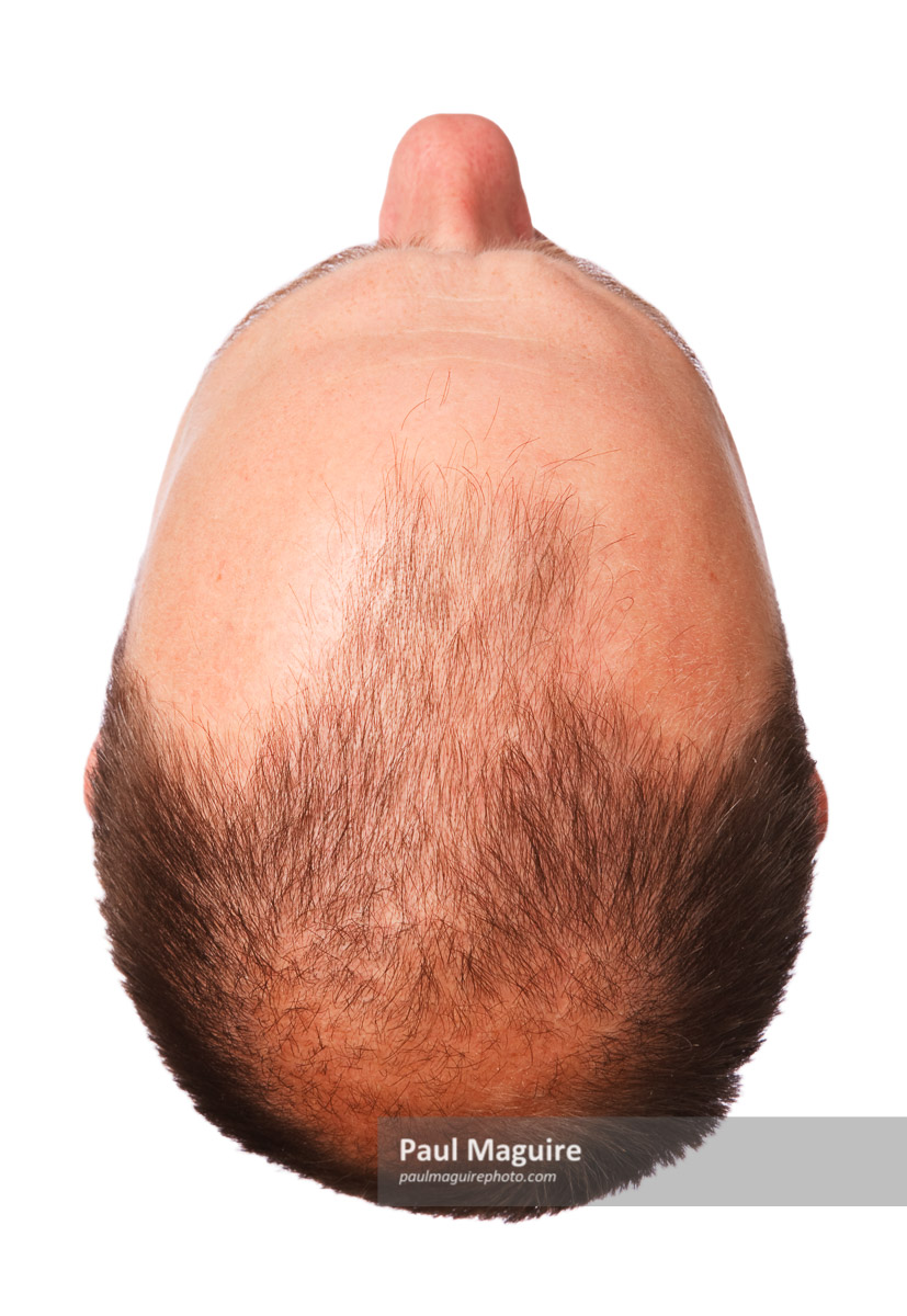 Male pattern baldness