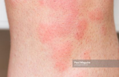 Hives on skin, urticaria rash, skin allergies, UK